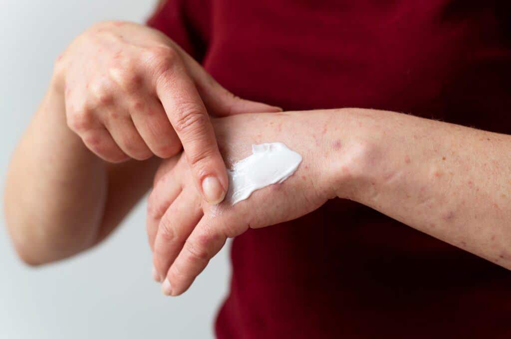 Photo of a person applying skincare regimen to improve skin elasticity, a practical tip for managing genetic malformation.