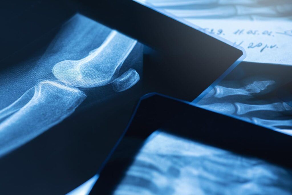 Advanced Technologies Enhancing Bone Healing